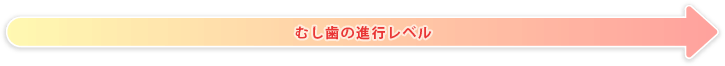 むし歯の進行レベル